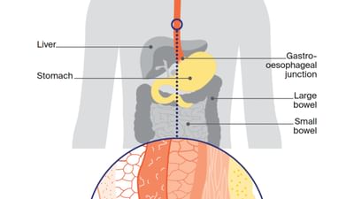 CCSA website body images Oesophageal Cancer
