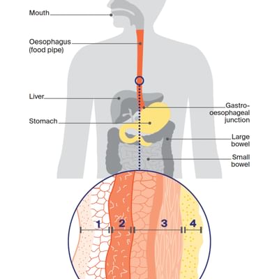 CCSA website body images Oesophageal Cancer