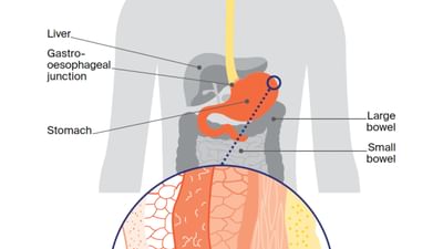 CCSA website body images Stomach Cancer