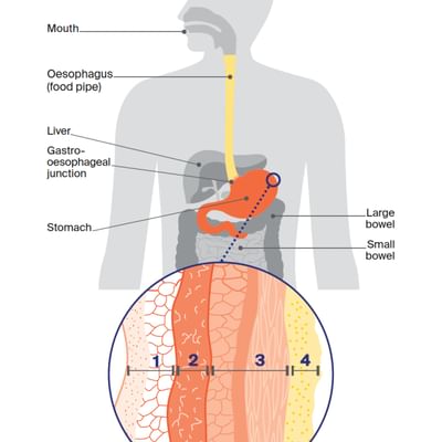 CCSA website body images Stomach Cancer