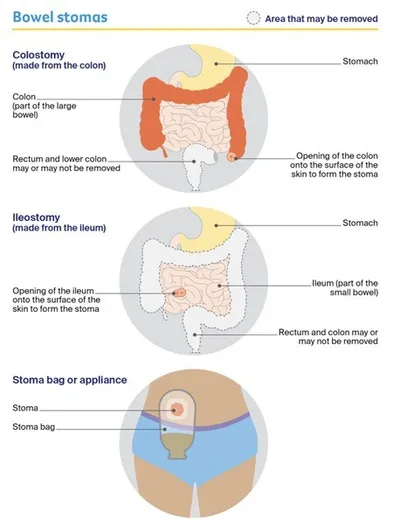 Diagram showing colostomy and ileostomy stomas on the abdomen with a stoma bag.