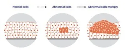 Three circular panels show normal cells, then abnormal cells, then abnormal cells multiplying.