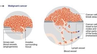 Cancer of unknown primary | Cancer Council SA