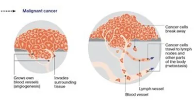 Diagram of malignant cancer in tissue: tumor grows blood vessels, invades tissue, cells spread.