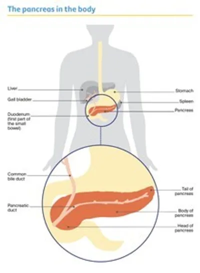Illustration of a human torso showing the pancreas in the abdomen, highlighted in orange.