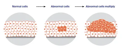Three circular panels show progression from normal epithelial cells to abnormal cells forming a mass.