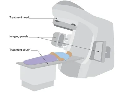 Patient lying on a treatment couch inside a radiotherapy linear accelerator.