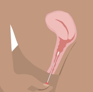 Minimalist illustration of a nude person with a urethral catheter inserted into the penis.
