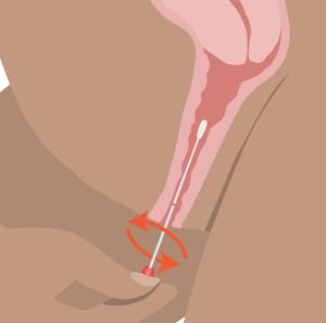 Illustration of a rectal dilator inserted with a twisting motion.
