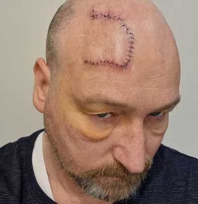 Person with a large curved sutured wound on the bald scalp and a yellow under-eye bruise.