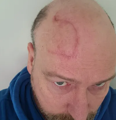 Person wearing blue hoodie, bald scalp with a large circular red scar on the crown, looking up