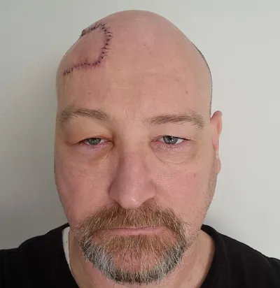 Close-up of a person with a stitched scar on the bald scalp, grey beard, neutral expression.