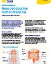 Poster on neuroendocrine tumours (NETs) with blue headings and orange organ diagrams.