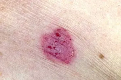 Close-up of a pink circular skin lesion with a reddish centre on pale skin.
