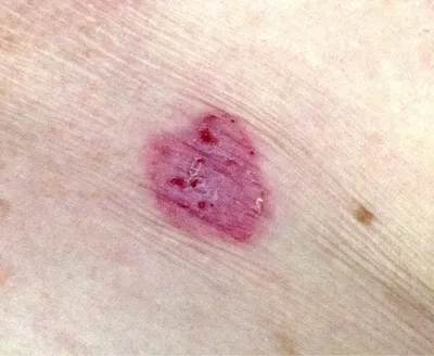 Close-up of a small pink circular skin lesion with a darker centre and tiny specks.