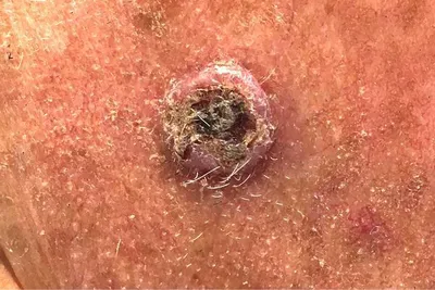 Close-up of pink skin with a crusty circular lesion in the centre.