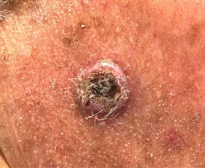 Close-up of a circular skin lesion with a dark crusty centre and surrounding dry, pinkish skin.
