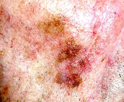 Close-up of pink skin with several irregular brown patches and fine hairs.