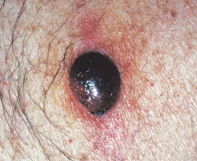Close-up of a dark, glossy circular skin lesion with surrounding reddened skin and visible hairs.