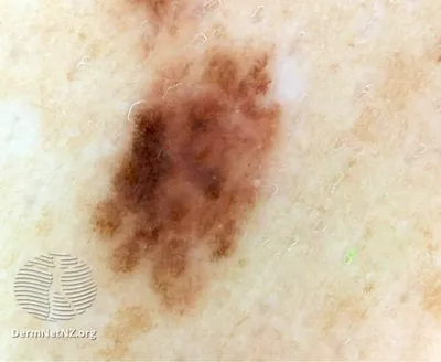 Close-up of an irregular, dark brown pigmented patch on light skin.