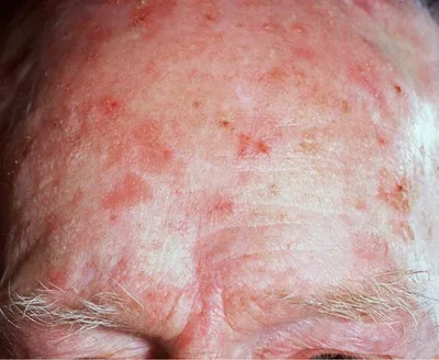 Close-up of a forehead with red inflamed patches, spots and fine wrinkles.