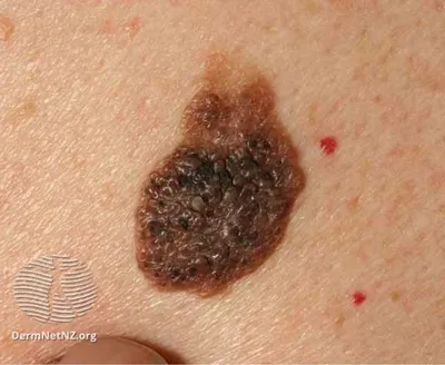 Close-up of a large, irregular, dark brown mole with a crusted surface on the skin.