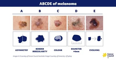 ABCDE of melanoma: asymmetry, border irregularity, colour, diameter >6mm, evolving.