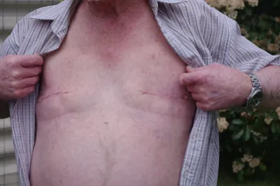 Male breast cancer survivor Robert shows the scars from his double mastectomy.